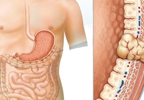 Khi nào nên đi khám bác sĩ nếu nghi ngờ mắc GIST?